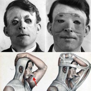 SHOCKING: Walter Yeo, the first person to receive plastic surgery, before (left) and after (right) skin flap surgery performed by Sir Harold Delf Gillies in 1917